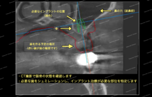 骨が少ないためインプラントが上顎洞に抜けてしまいます